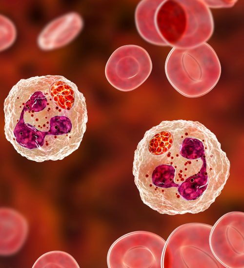 Anaplasmosis: A Common Lyme Co-infection